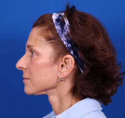 Facelift/Neck Lift Before & After Gallery - Patient 26562764 - Image 6