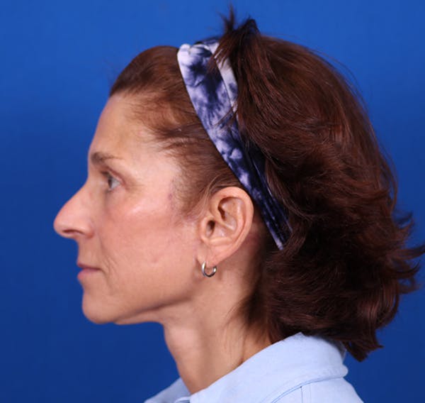 Facelift/Neck Lift Before & After Gallery - Patient 26562764 - Image 6