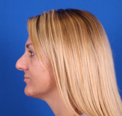 Rhinoplasty Before & After Gallery - Patient 26562820 - Image 1