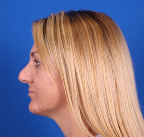 Rhinoplasty Before & After Gallery - Patient 26562820 - Image 1