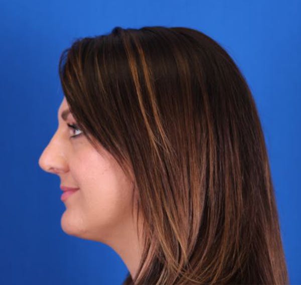 Rhinoplasty Before & After Gallery - Patient 26562820 - Image 2