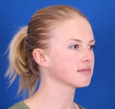 Rhinoplasty Before & After Gallery - Patient 26562821 - Image 4