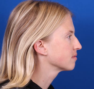 Rhinoplasty Before & After Gallery - Patient 26562821 - Image 1