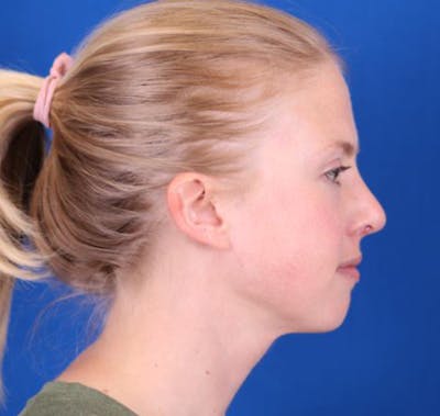 Rhinoplasty Before & After Gallery - Patient 26562821 - Image 2