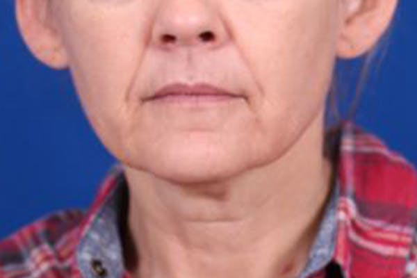 Facelift/Neck Lift Before & After Gallery - Patient 27116500 - Image 1