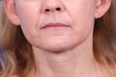 Facelift/Neck Lift Before & After Gallery - Patient 27116500 - Image 2