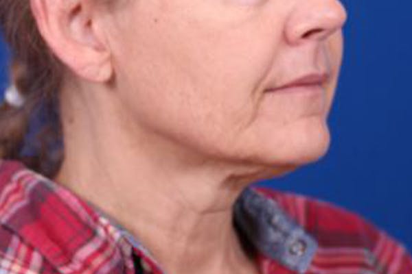 Facelift/Neck Lift Before & After Gallery - Patient 27116500 - Image 3