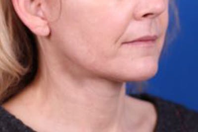 Facelift/Neck Lift Before & After Gallery - Patient 27116500 - Image 4