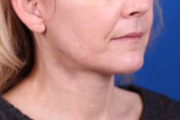 Facelift/Neck Lift Before & After Gallery - Patient 27116500 - Image 4