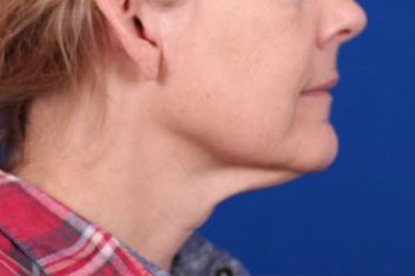 Facelift/Neck Lift Before & After Gallery - Patient 27116500 - Image 5