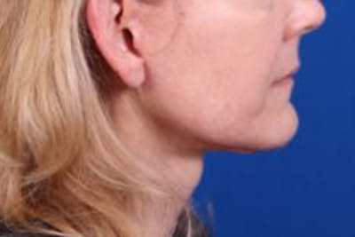 Facelift/Neck Lift Before & After Gallery - Patient 27116500 - Image 6