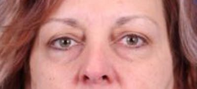 Blepharoplasty Before & After Gallery - Patient 35025648 - Image 1