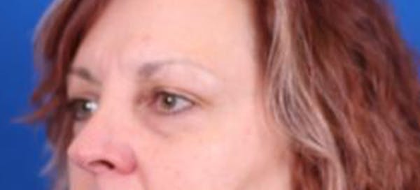 Blepharoplasty Before & After Gallery - Patient 35025648 - Image 3