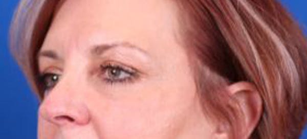 Blepharoplasty Before & After Gallery - Patient 35025648 - Image 4