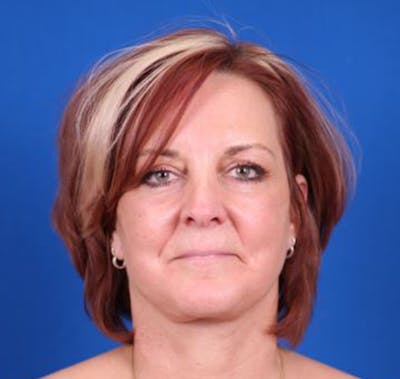 Facelift/Neck Lift Before & After Gallery - Patient 35032688 - Image 2