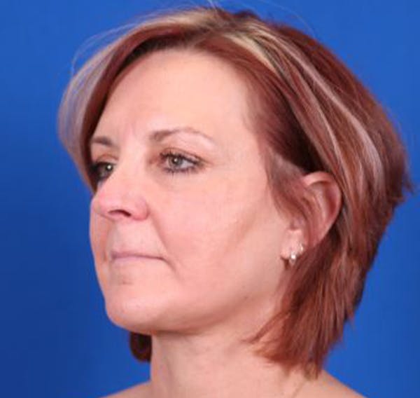 Facelift/Neck Lift Before & After Gallery - Patient 35032688 - Image 4
