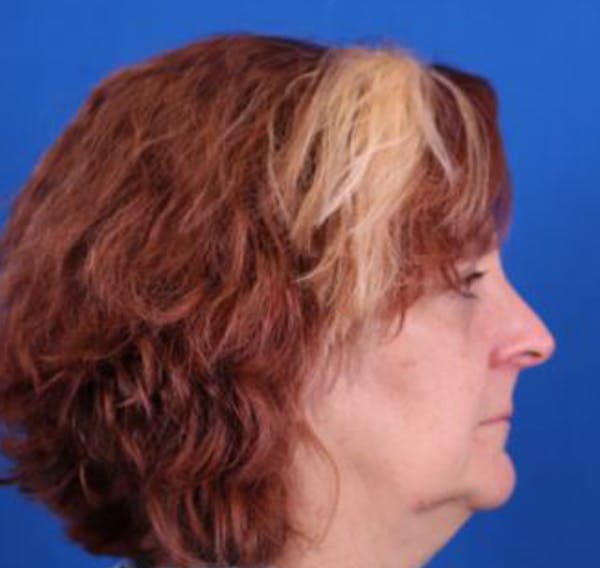 Facelift/Neck Lift Before & After Gallery - Patient 35032688 - Image 5