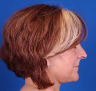 Facelift/Neck Lift Before & After Gallery - Patient 35032688 - Image 6