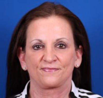 Facelift/Neck Lift Before & After Gallery - Patient 35040347 - Image 2