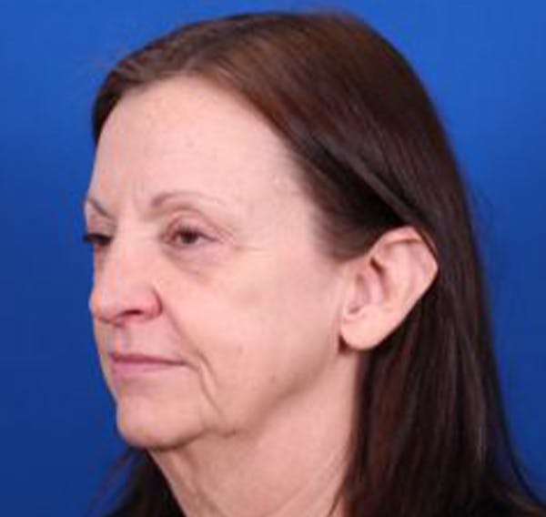 Facelift/Neck Lift Before & After Gallery - Patient 35040347 - Image 3