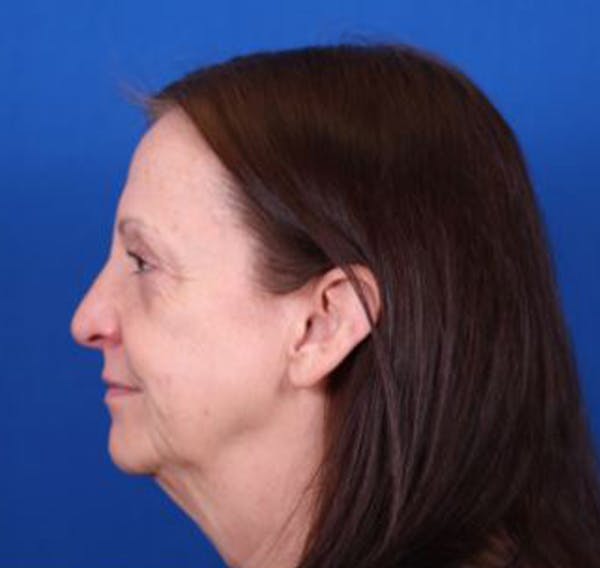 Facelift/Neck Lift Before & After Gallery - Patient 35040347 - Image 5