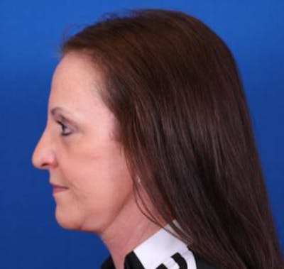 Facelift/Neck Lift Before & After Gallery - Patient 35040347 - Image 6