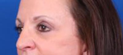 Blepharoplasty Before & After Gallery - Patient 35040494 - Image 4