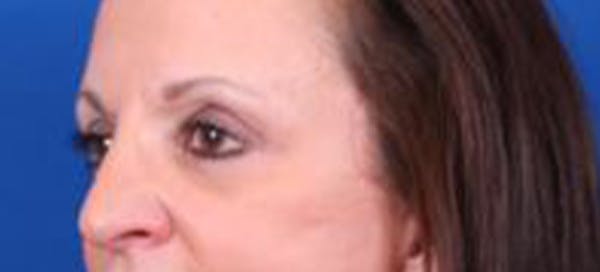 Blepharoplasty Before & After Gallery - Patient 35040494 - Image 4