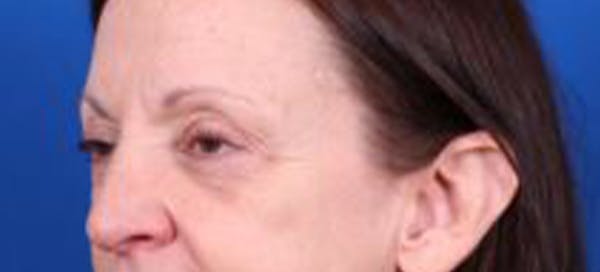 Blepharoplasty Before & After Gallery - Patient 35040494 - Image 3