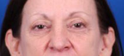 Blepharoplasty Before & After Gallery - Patient 35040494 - Image 1