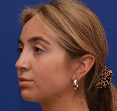 Rhinoplasty Before & After Gallery - Patient 39158835 - Image 4