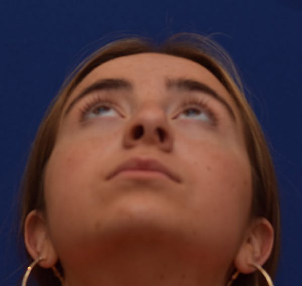 Rhinoplasty Before & After Gallery - Patient 39158835 - Image 7
