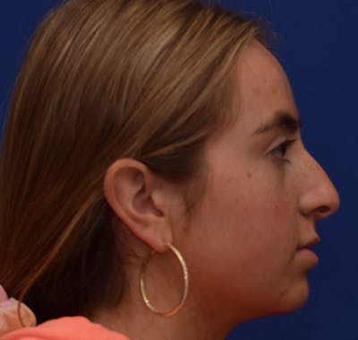 Rhinoplasty Before & After Gallery - Patient 39158835 - Image 1