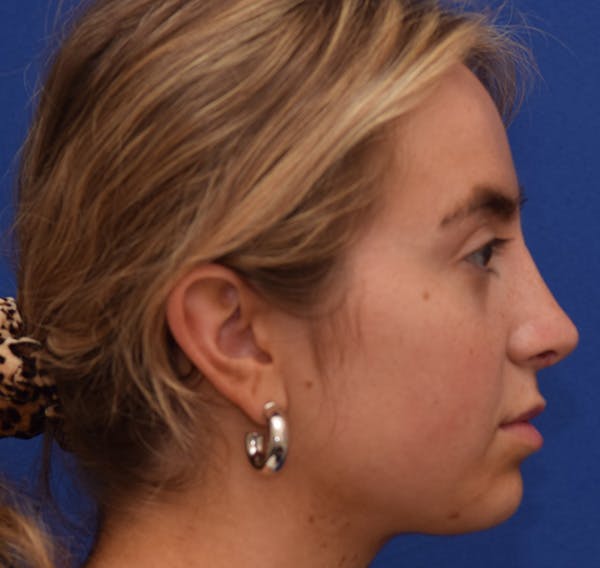 Rhinoplasty Before & After Gallery - Patient 39158835 - Image 8