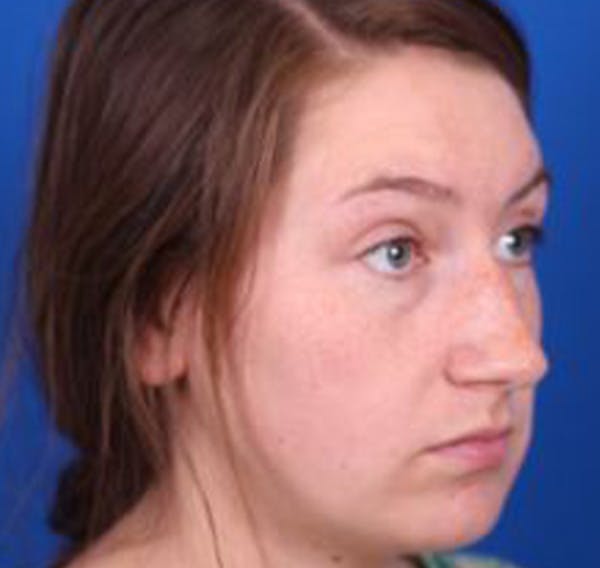 Rhinoplasty Before & After Gallery - Patient 39166559 - Image 3
