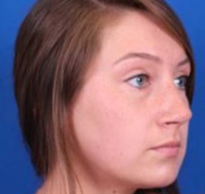 Rhinoplasty Before & After Gallery - Patient 39166559 - Image 4