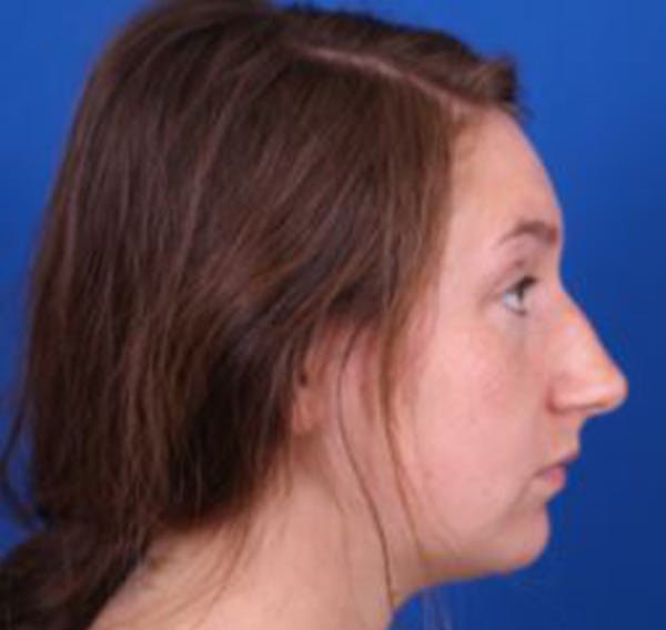 Rhinoplasty Before & After Gallery - Patient 39166559 - Image 1