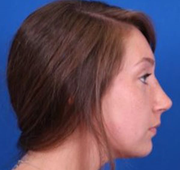 Rhinoplasty Before & After Gallery - Patient 39166559 - Image 2