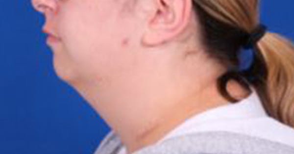 Neck deFINE Before & After Gallery - Patient 54673847 - Image 5
