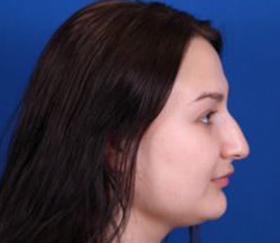 Rhinoplasty Before & After Gallery - Patient 54674416 - Image 1