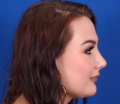 Rhinoplasty Before & After Gallery - Patient 54674416 - Image 2
