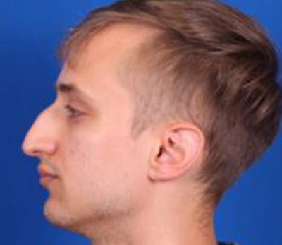 Rhinoplasty Before & After Gallery - Patient 54674417 - Image 1