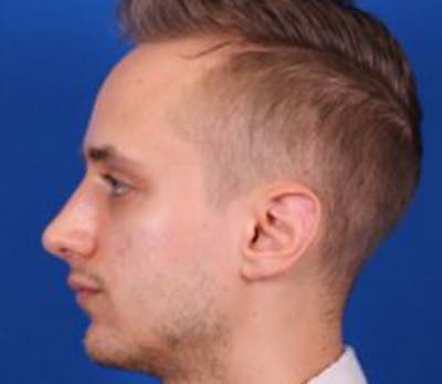 Rhinoplasty Before & After Gallery - Patient 54674417 - Image 2