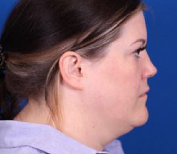 Neck deFINE Before & After Gallery - Patient 102925369 - Image 3