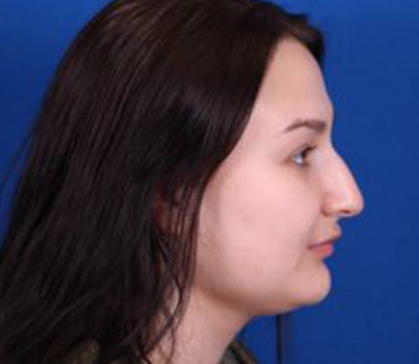 Rhinoplasty Before & After Gallery - Patient 102925397 - Image 1