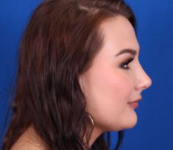 Rhinoplasty Before & After Gallery - Patient 102925397 - Image 2