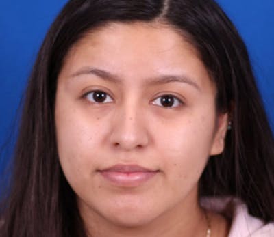 Rhinoplasty Before & After Gallery - Patient 102925398 - Image 1