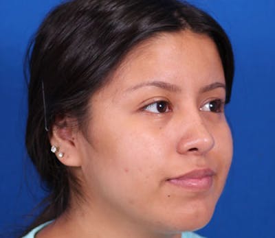 Rhinoplasty Before & After Gallery - Patient 102925398 - Image 4
