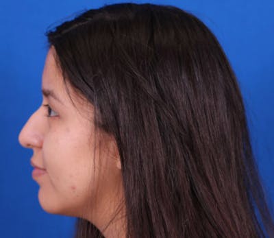 Rhinoplasty Before & After Gallery - Patient 102925398 - Image 1