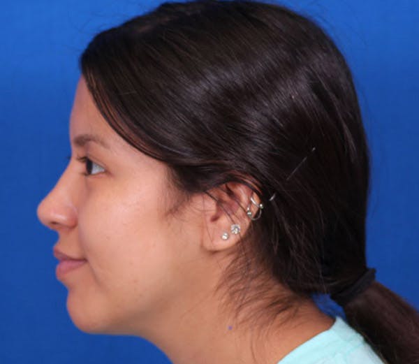 Rhinoplasty Before & After Gallery - Patient 102925398 - Image 2